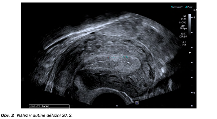 Obr č. 2 Nález v dutině děložní 20. 2.
