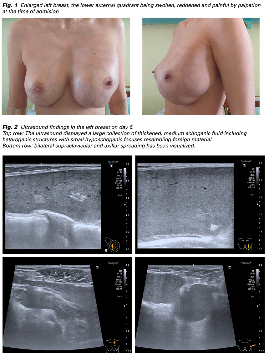 Late inflammatory complication 20 years after filler application for breast  augmentation – case report