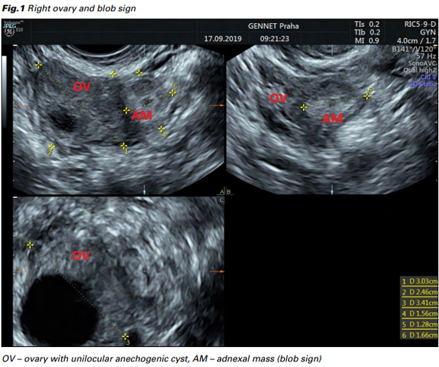 Right ovary and blob sign